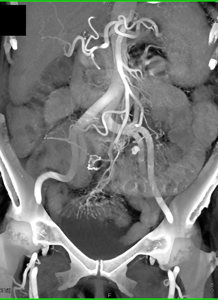 Inflamed Ischemic Small Bowel Loop - CTisus CT Scan