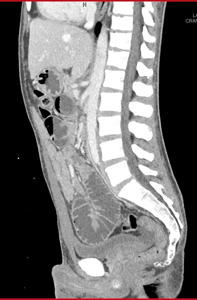 Small Bowel Obstruction due to Metastatic Renal Cell Carcinoma - CTisus CT Scan