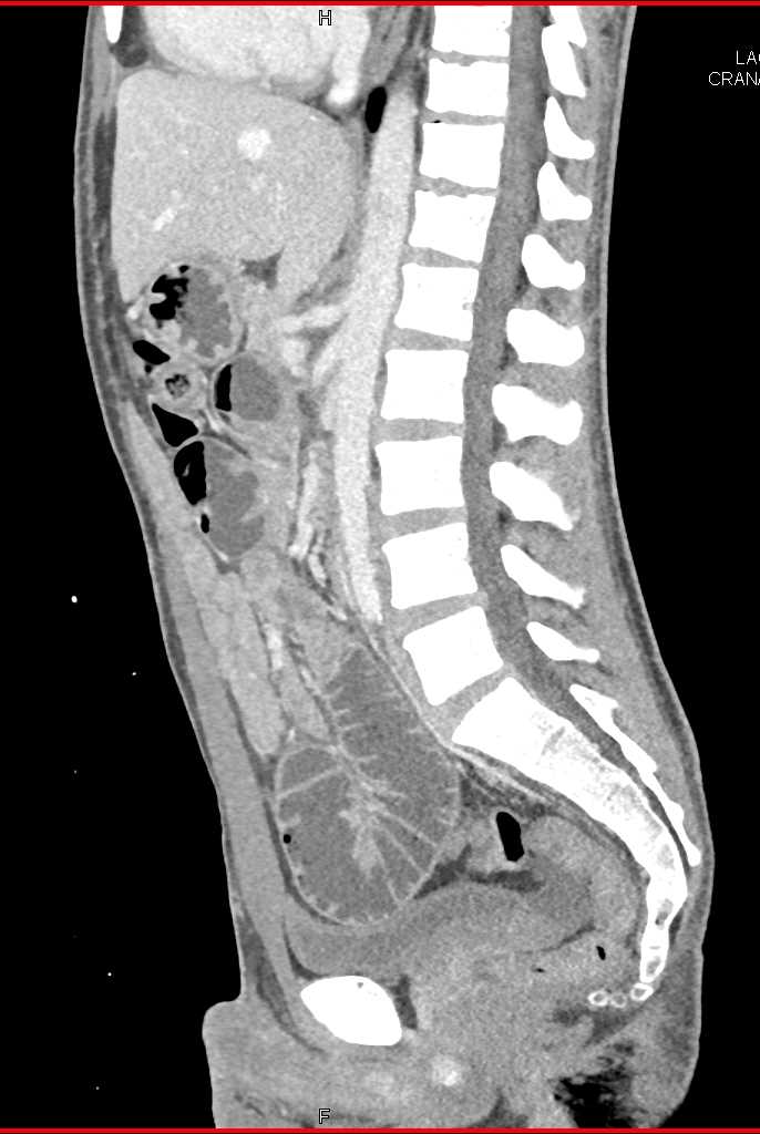Small Bowel Obstruction due to Metastatic Renal Cell Carcinoma - CTisus CT Scan