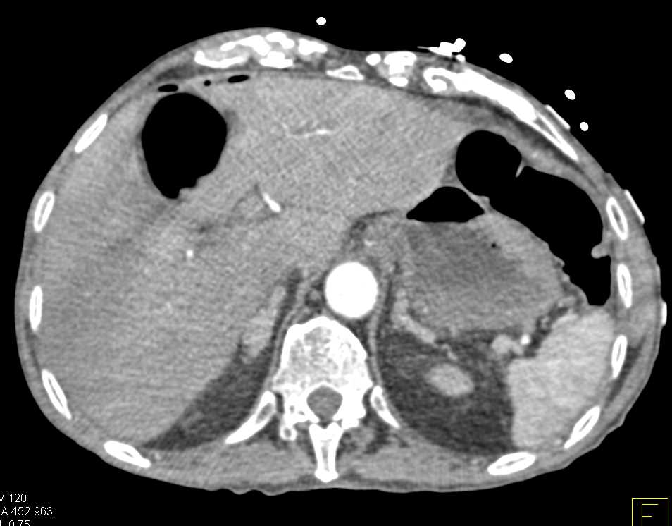 Incarcerated Inguinal Hernia with Perforation and Pneumoperitoneum - CTisus CT Scan