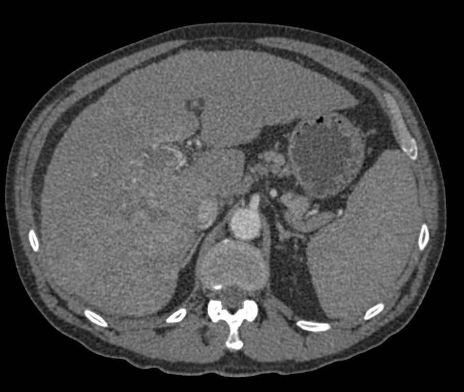 Carcinomatosis with Extensive Mediastinal Tumor - CTisus CT Scan