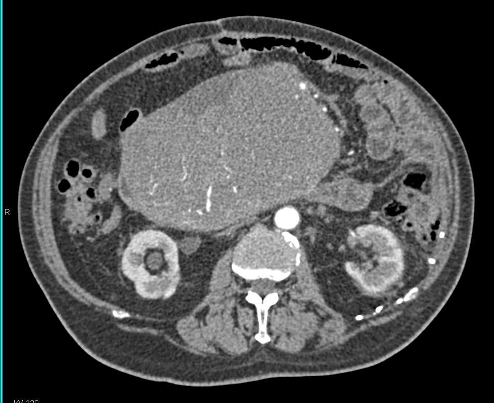 Small Bowel GIST Tumor - Gastrointestinal Case Studies - CTisus CT Scanning