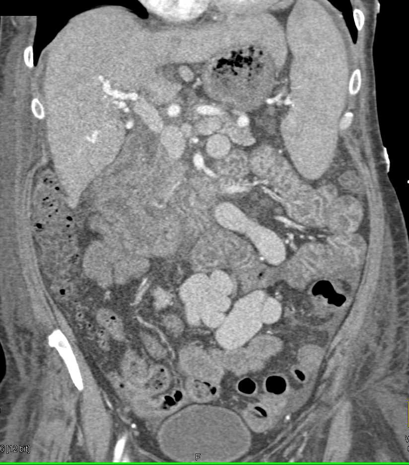 Sprue with Thickened Proximal Small Bowel - CTisus CT Scan