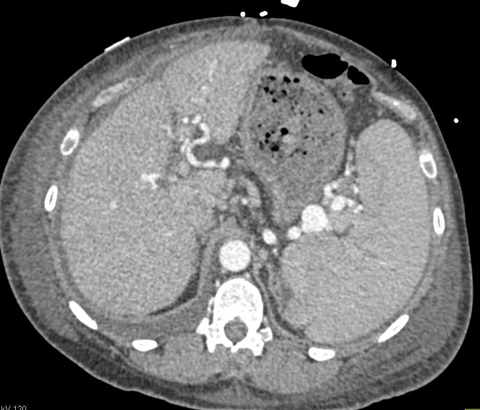 Sprue with Thickened Proximal Small Bowel and Varices - CTisus CT Scan