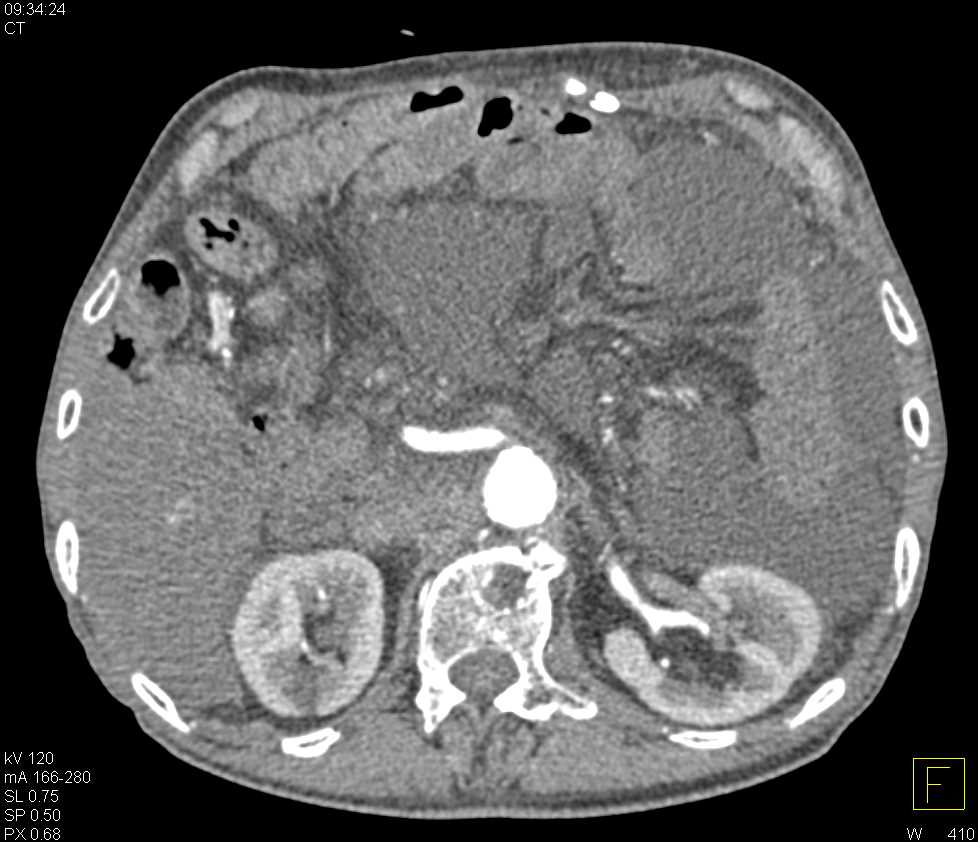 Carcinoid Tumor in the Root of the Mesentery - CTisus CT Scan