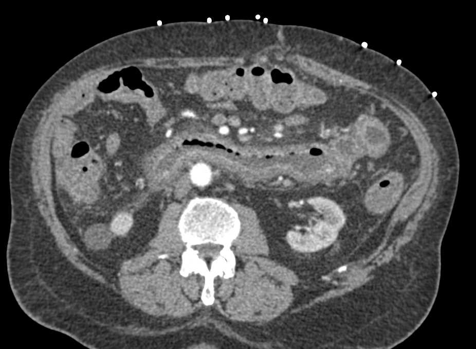 Severe Infectious Enteritis Involving the Duodenum and Proximal Jejunum - CTisus CT Scan
