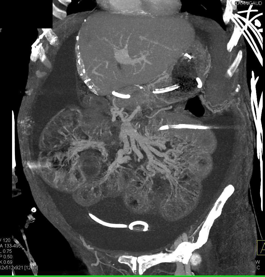 Ischemic Bowel and Tethered Mesenteric Vasculature - CTisus CT Scan