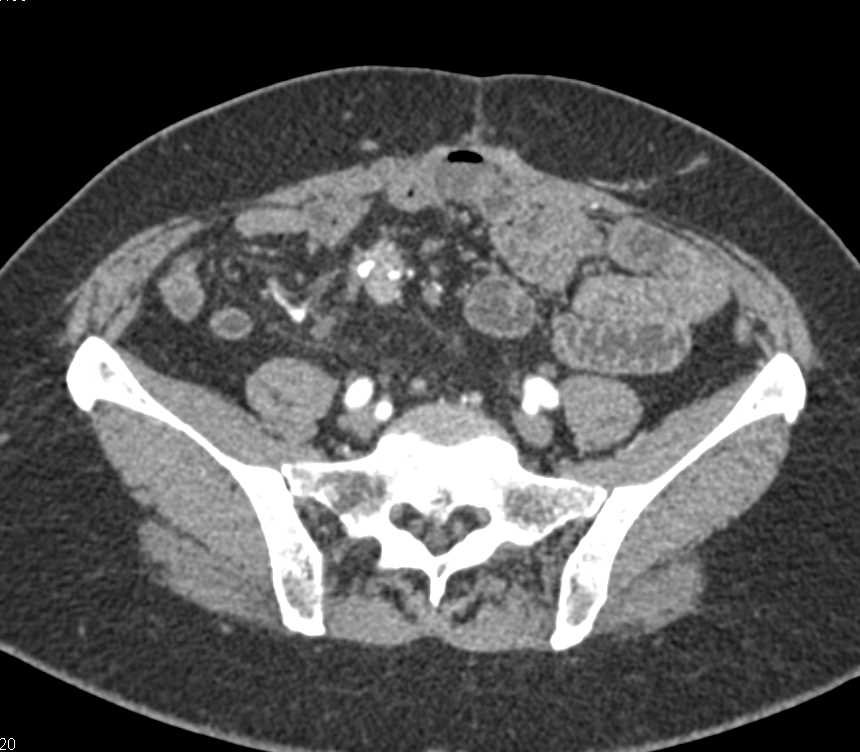 Carcinoid Tumor with Desmoplastic Reaction in Mesentery - CTisus CT Scan