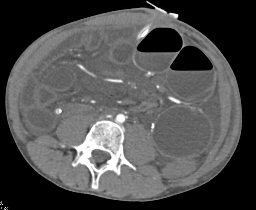 Distal Small Bowel Obstruction (SBO) due to Adhesions - CTisus CT Scan