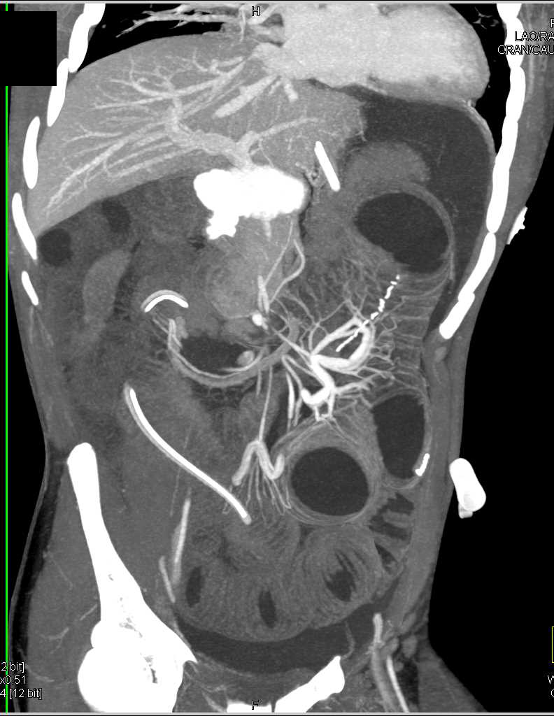 Distal Small Bowel Obstruction (SBO) due to Adhesions - CTisus CT Scan