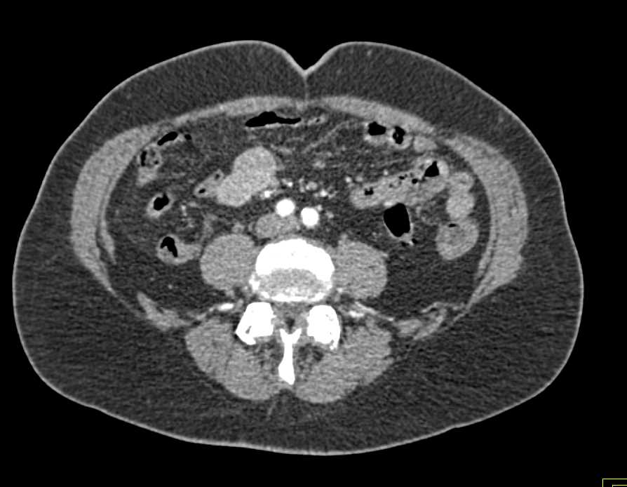 Carcinoid Tumor in the Root of the Mesentery - CTisus CT Scan