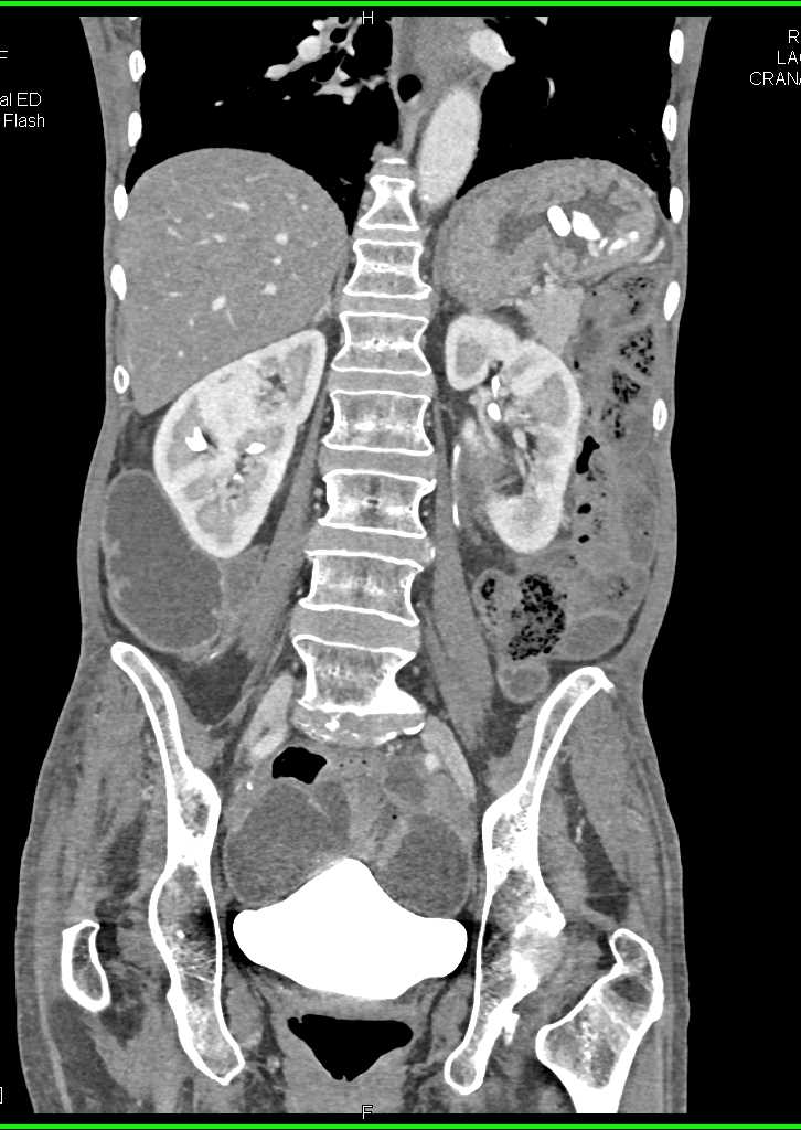 Distal Small Bowel Obstruction - CTisus CT Scan