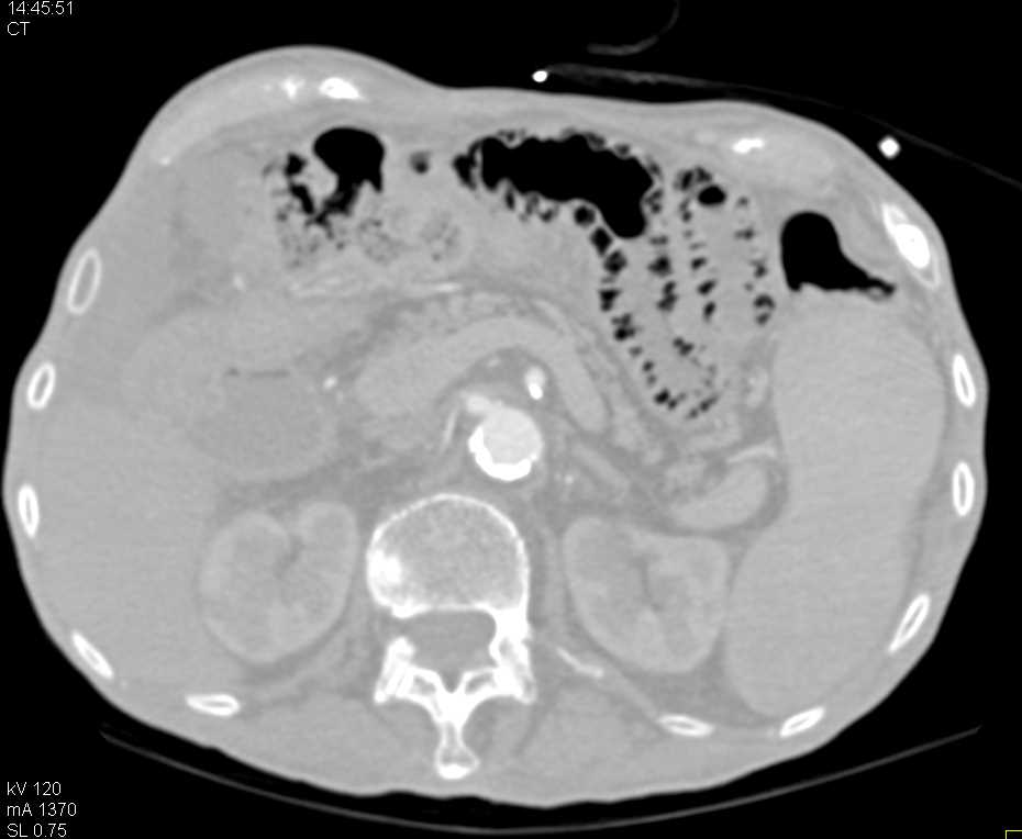 Pneumatosis with Ischemic Small Bowel - CTisus CT Scan