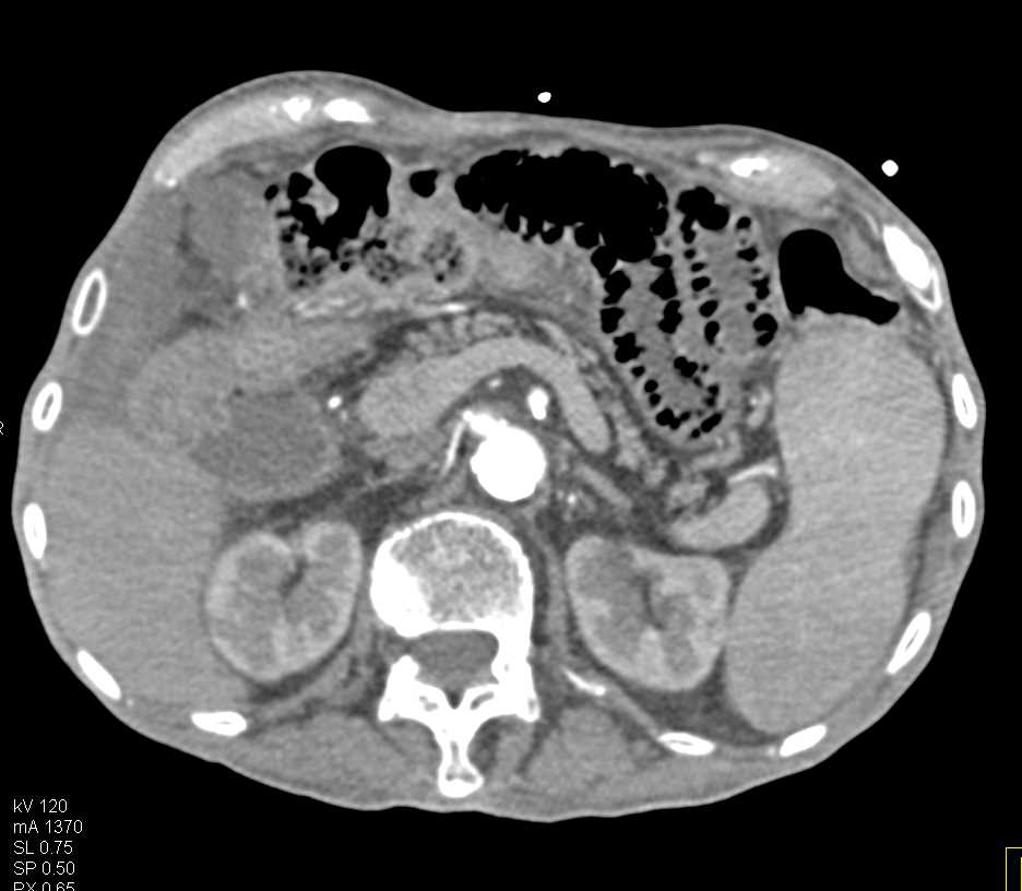 Pneumatosis with Ischemic Small Bowel - CTisus CT Scan