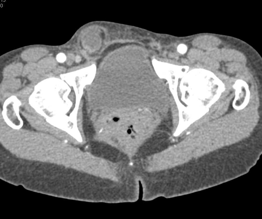 Small Bowel Obstruction due to a Right Inguinal Hernia - CTisus CT Scan
