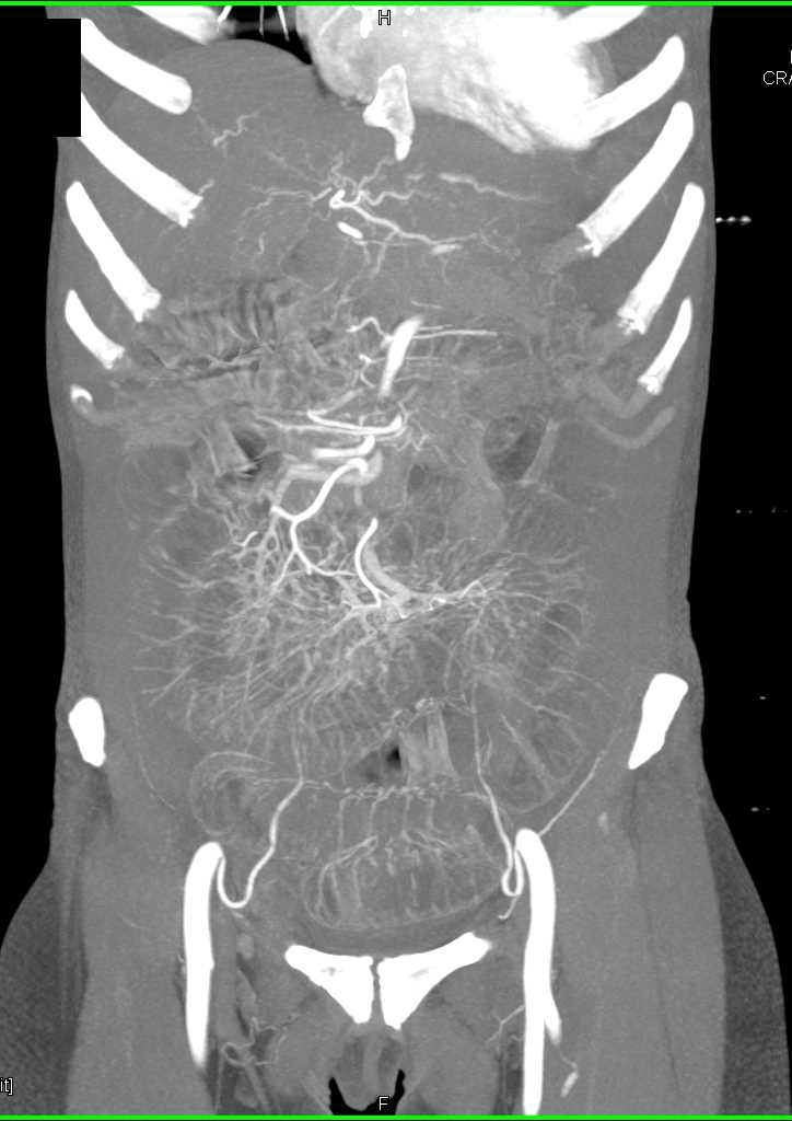 Small Bowel Obstruction due to a Right Inguinal Hernia - CTisus CT Scan