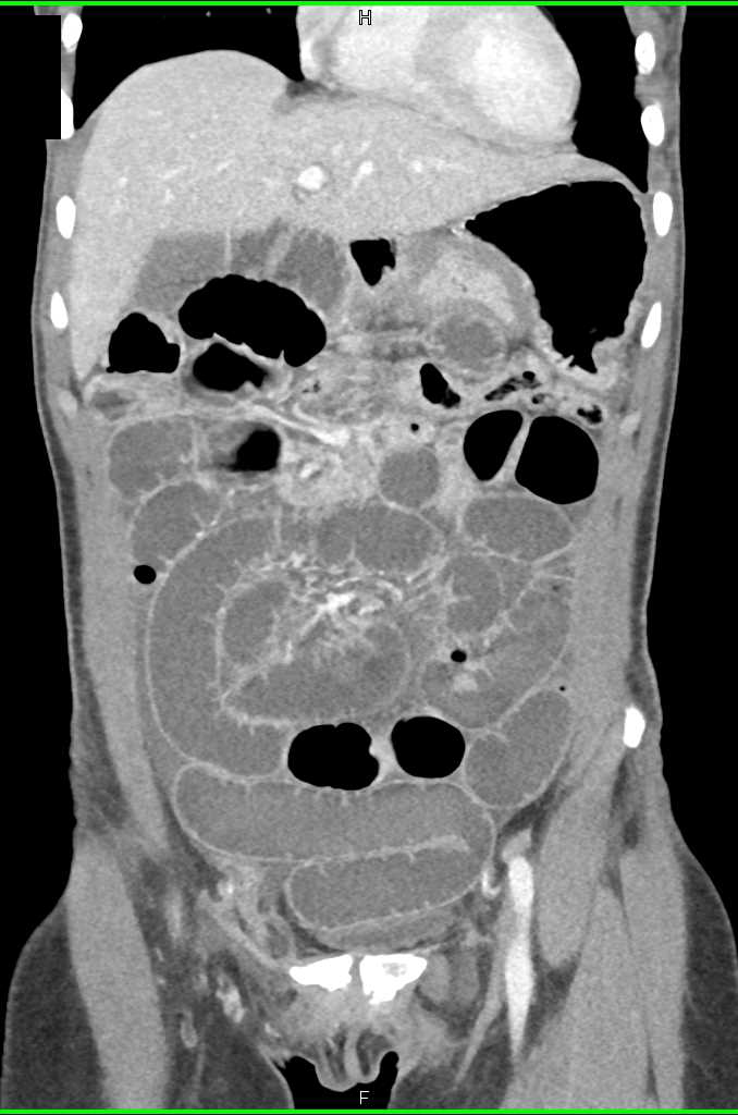Small Bowel Obstruction due to an Incarcerated Right Inguinal Hernia - CTisus CT Scan