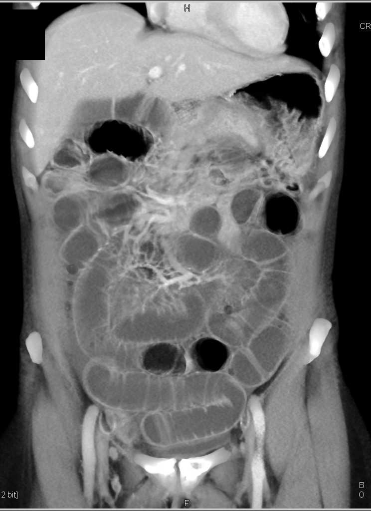 Small Bowel Obstruction due to an Incarcerated Right Inguinal Hernia - CTisus CT Scan