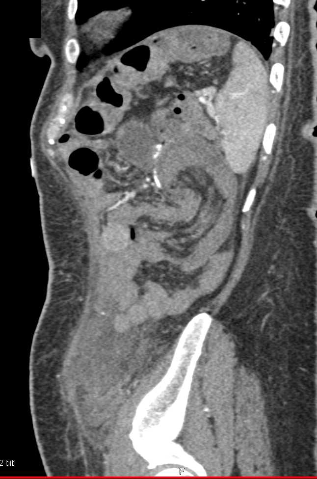 Multiple Small Bowel Intussusceptions - CTisus CT Scan
