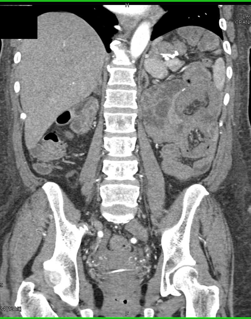 Multiple Small Bowel Intussusceptions - CTisus CT Scan