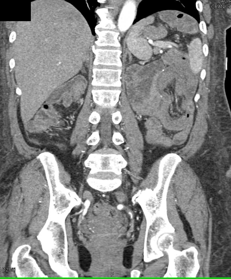 Multiple Small Bowel Intussusceptions Without Tumor in End Stage Renal Disease (ESRD) Patient - CTisus CT Scan