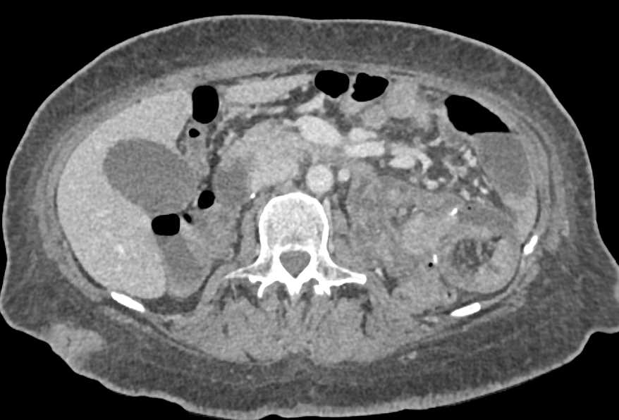 Multiple Small Bowel Intussusceptions Without Tumor in End Stage Renal Disease (ESRD) Patient - CTisus CT Scan