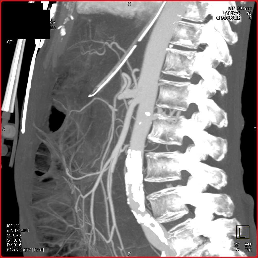 Narrowed Celiac Artery and Ischemic Bowel Changes due to Ischemia - CTisus CT Scan