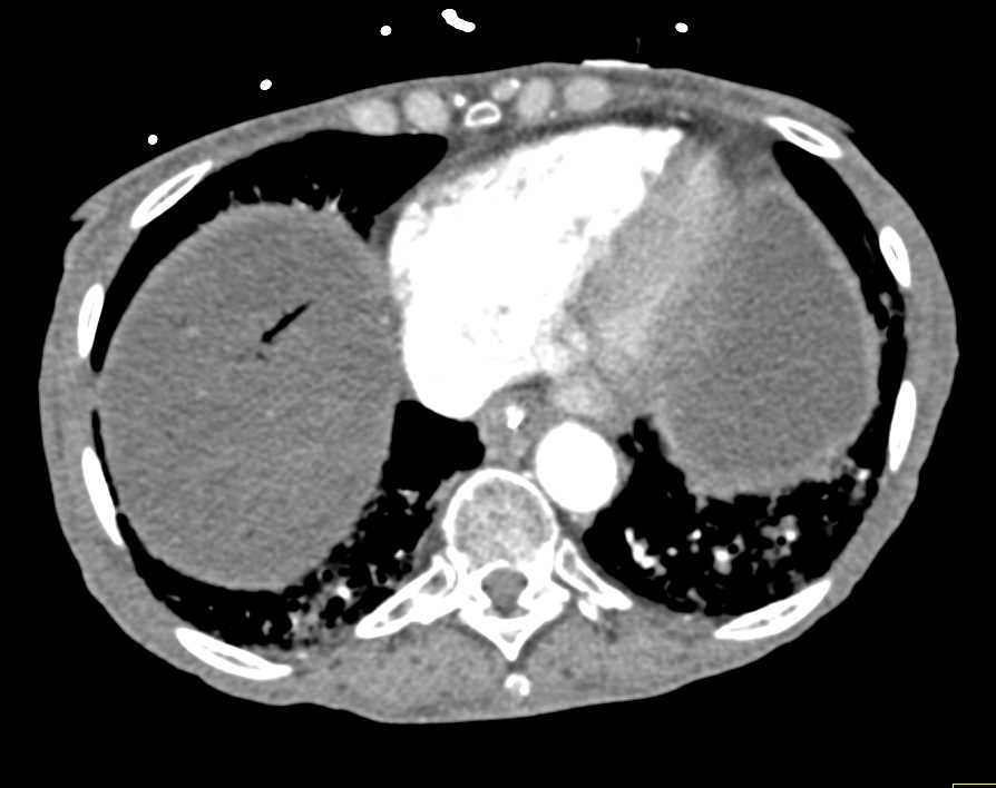 Ischemic Bowel with Pneumatosis and Air in Hepatic Veins - CTisus CT Scan