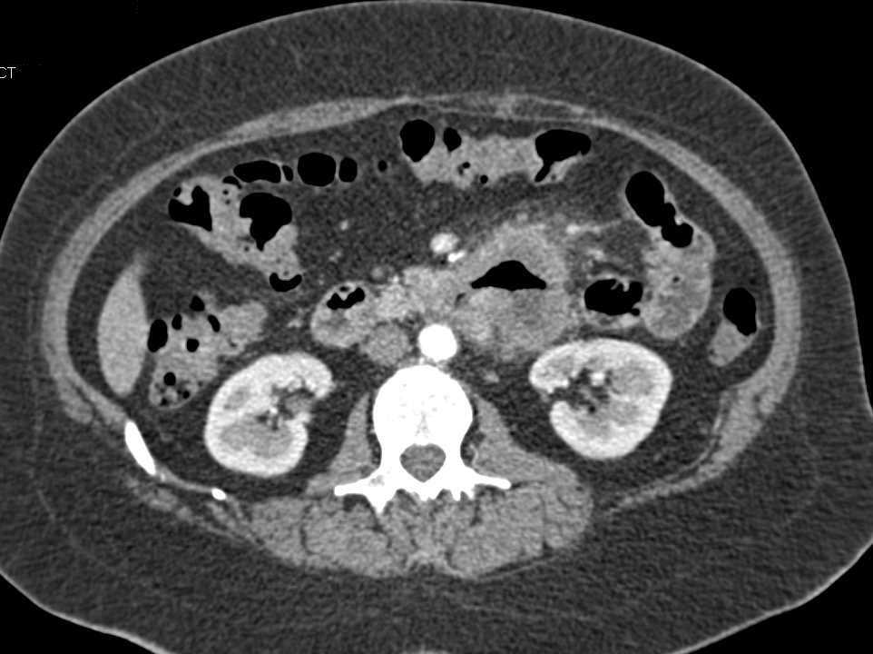 Carcinoma of the Fourth Portion of the Duodenum - CTisus CT Scan