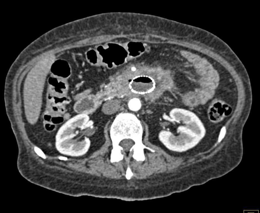 Carcinoma of the Fourth Portion of the Duodenum with Endoluminal Stent - CTisus CT Scan