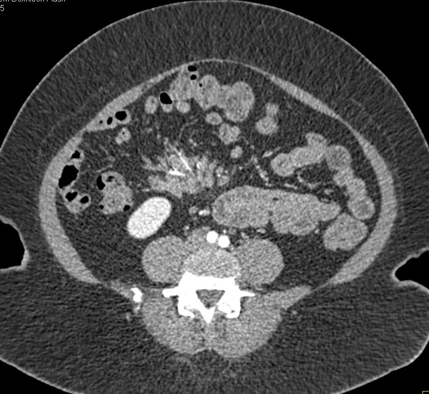 Carcinoid Tumor in the Root of the Mesentery with Vessel Encasement - CTisus CT Scan