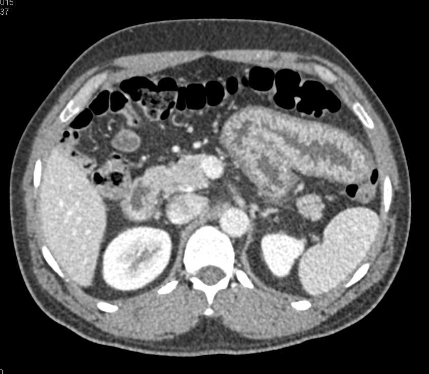 Infectious Enteritis Involving the Small Bowel - CTisus CT Scan