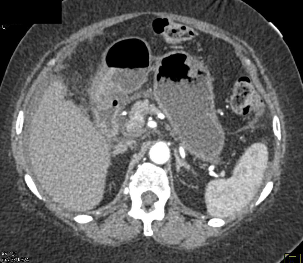 Duodenal Ulcer with Local Inflammation - CTisus CT Scan