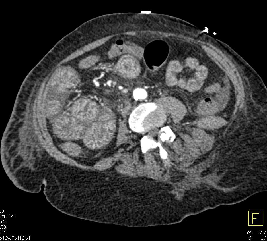 Small Bowel Enteritis - CTisus CT Scan