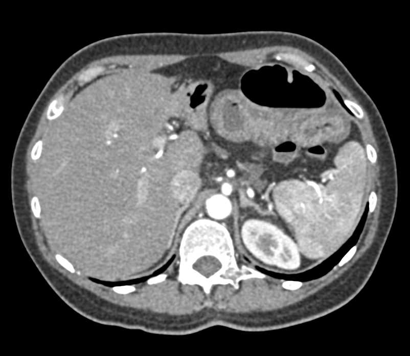 Dilated Small Bowel Loops with Strictures due to Enteritis - CTisus CT Scan