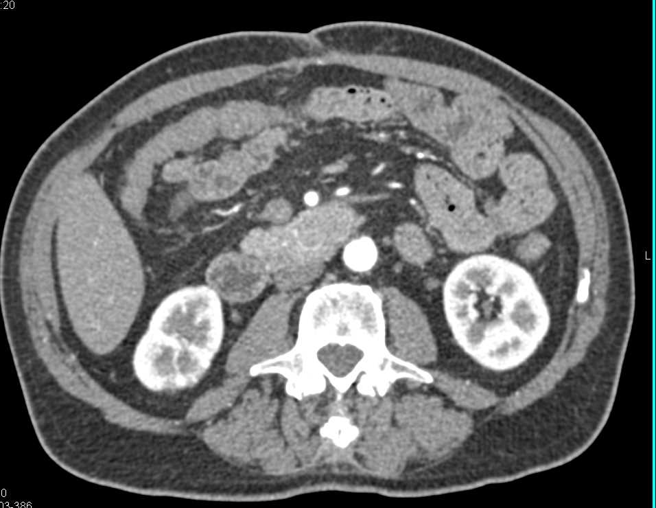 GIST Tumor Arising off the 4th Portion of the Duodenum - CTisus CT Scan