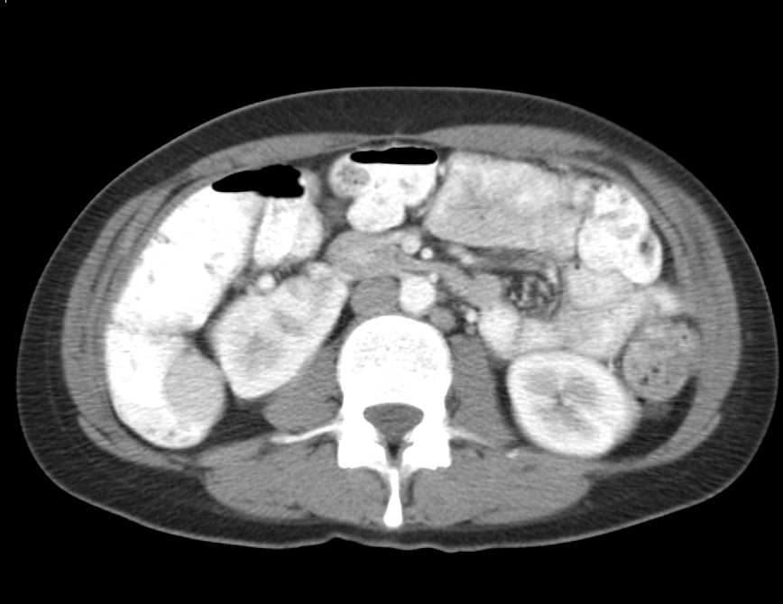 Crohn's Disease with Bowel Strictures and Fibrofatty Proliferation in the Mesentery - CTisus CT Scan