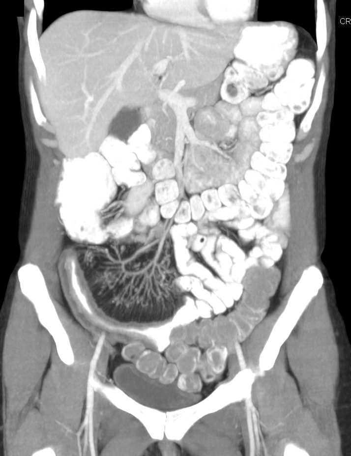 Crohn's Disease with Bowel Strictures and Fibrofatty Proliferation in the Mesentery - CTisus CT Scan