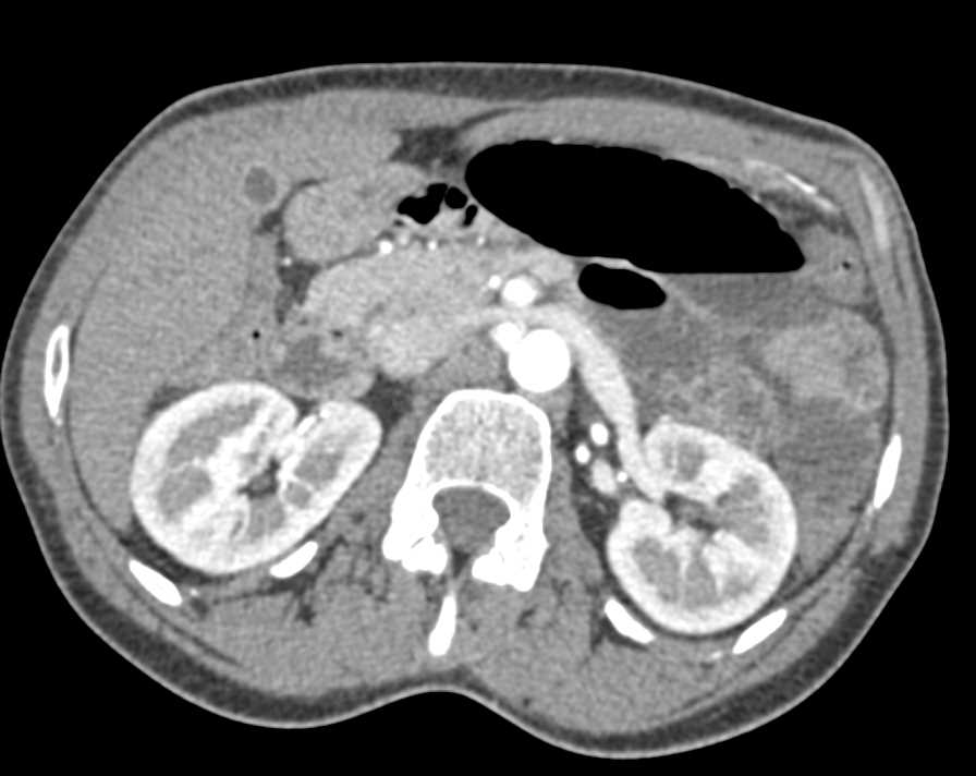 Small Bowel Obstruction (SBO) with Distal Small Bowel Obstruction due to Adhesions - CTisus CT Scan