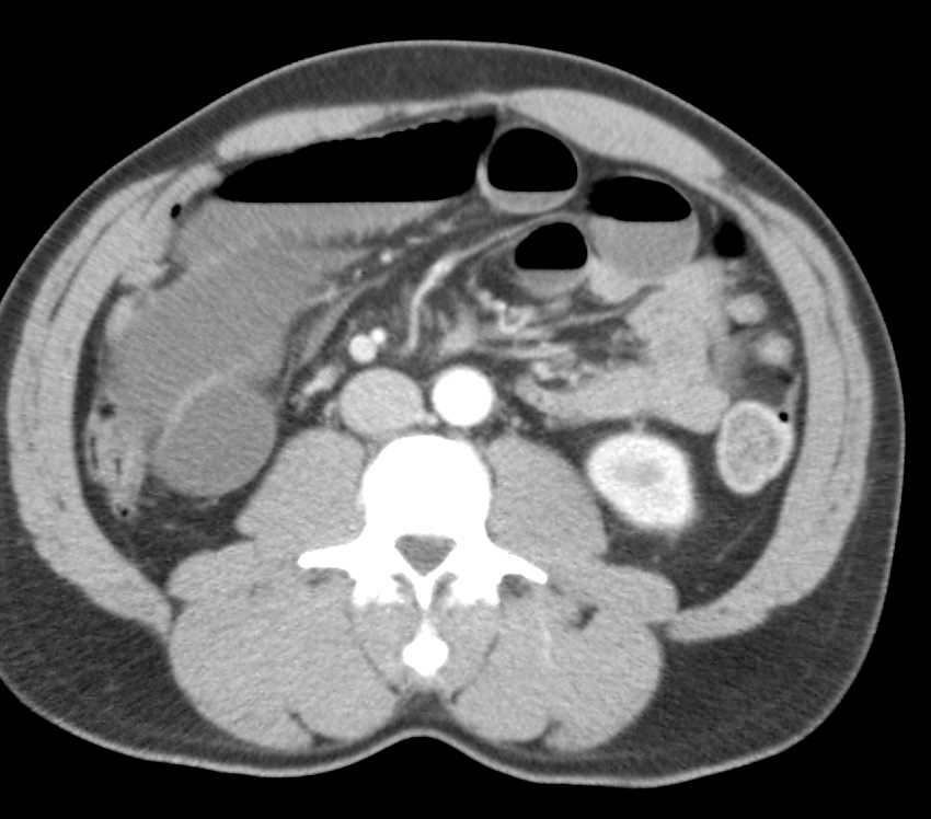 Distal Small Bowel Obstruction (SBO) with no mass seen - CTisus CT Scan