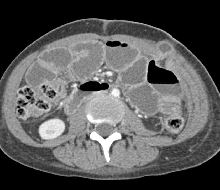 Small Bowel Obstruction due to Adhesions - CTisus CT Scan