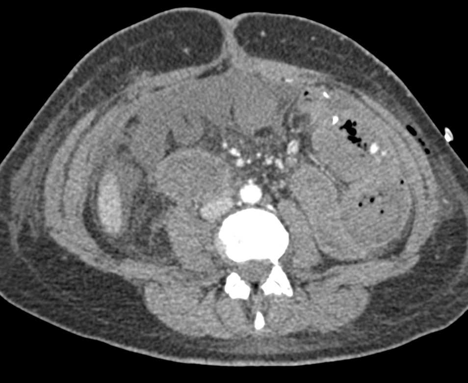 Active Bleed in the Small Bowel in the Left Lower Quadrant - CTisus CT Scan