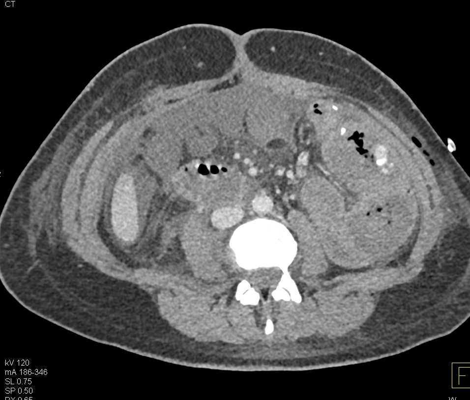 Active Bleed in the Small Bowel in the Left Lower Quadrant - CTisus CT Scan