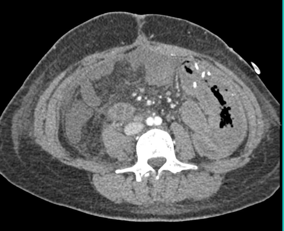 Active Bleed in the Small Bowel in the Left Lower Quadrant - CTisus CT Scan