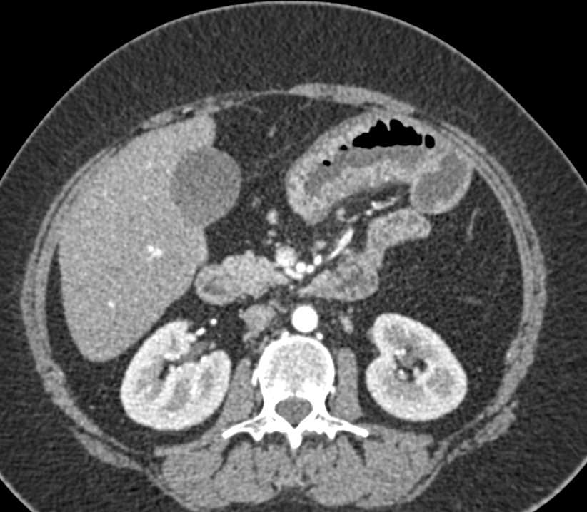 Thickened Proximal Small Bowel with Enteritis - CTisus CT Scan