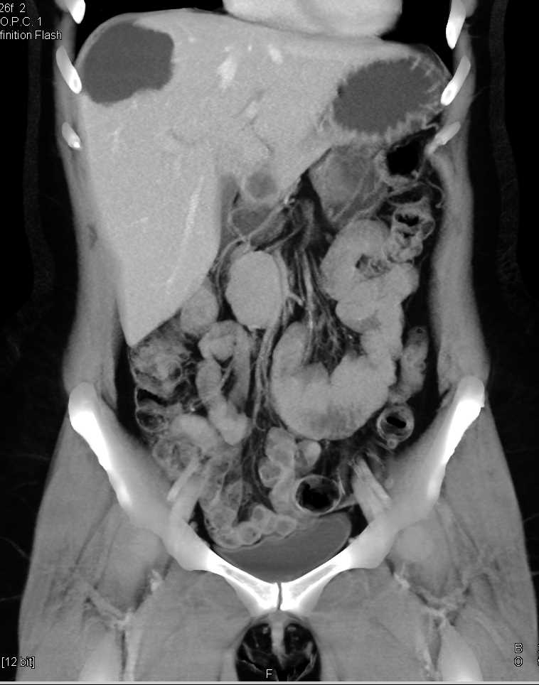 Subtle Carcinoid Tumor in the Terminal Ileum - CTisus CT Scan