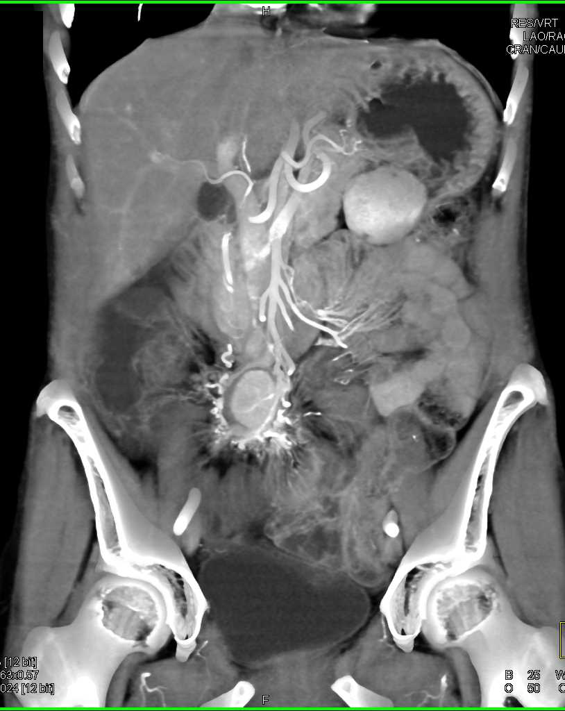 Carcinoid Tumor with Mesenteric Mass and Desmoplastic Reaction and Liver Metastases - CTisus CT Scan