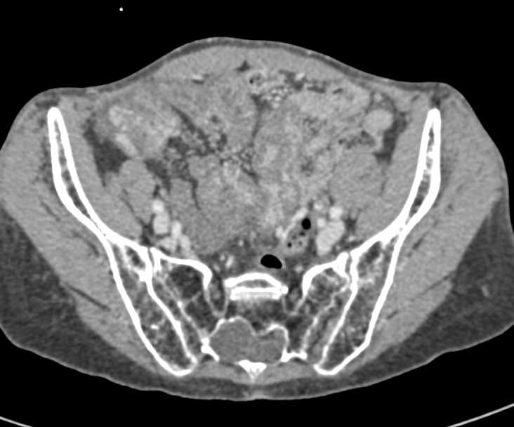 Carcinoid Tumor with Mesenteric Mass and Desmoplastic Reaction and Liver Metastases - CTisus CT Scan