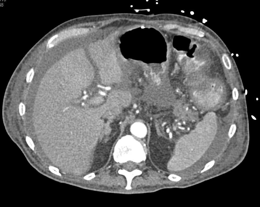 Inflamed Colon with Enteritis - CTisus CT Scan