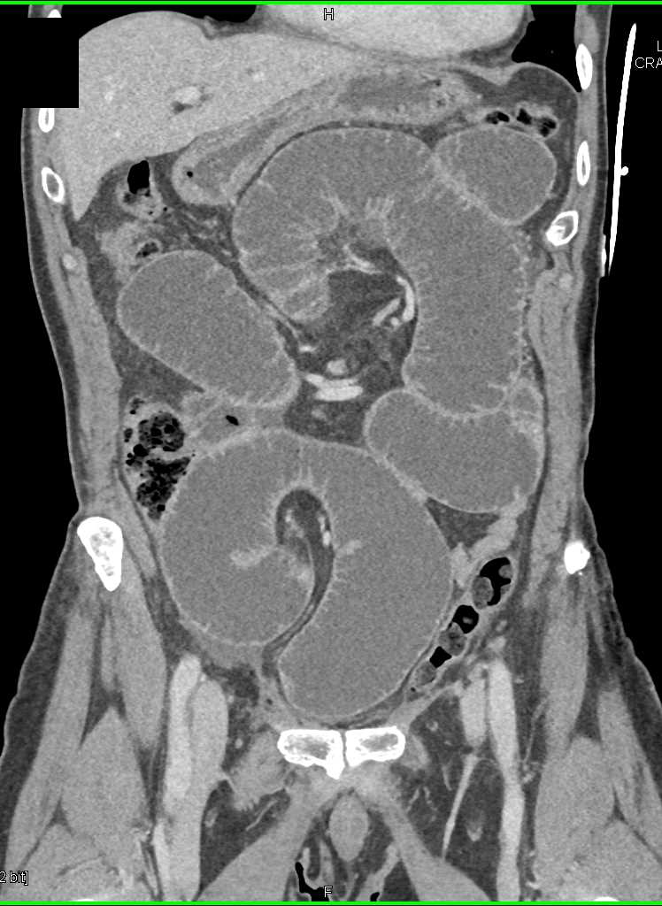 Small Bowel Obstruction (SBO) due to Distal Adhesions - CTisus CT Scan